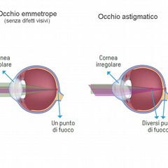 L’astigmatismo non corretto può provocare stanchezza e mal di testa