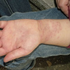 eczema processionaria