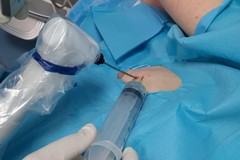 Nuova tecnica radiologica al "Bonomo" di Andria con la crioablazione