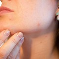 Psoriasi, l'11 marzo un open day contro la malattia della pelle