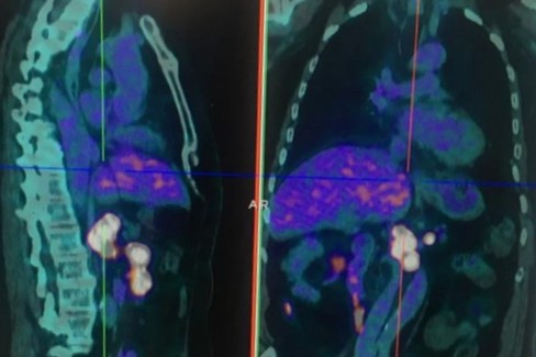 Tumori neuroendocrini: nella Bat prima Pet in Puglia con Gallio 68